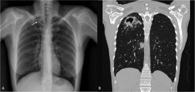Chest X-ray showing tuberculosis infection