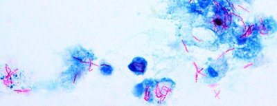 Microscopic image of acid-fast stained Mycobacterium tuberculosis