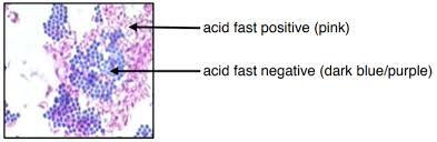 Acid-fast positive and negative staining results