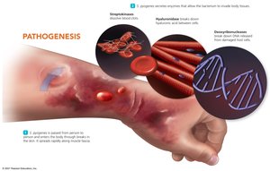 Pathogenesis of necrotizing fasciitis
