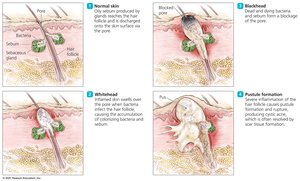 Development of acne