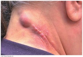 Cat scratch disease lesion