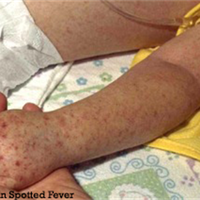 RMSF rash on arm