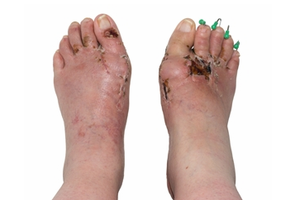 Cutaneous anthrax eschar