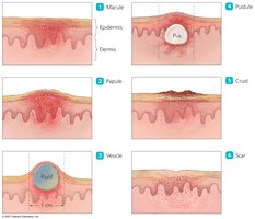 Stages of poxviral skin lesions