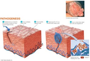Pathogenesis of papillomas (warts)