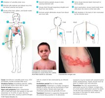 Chickenpox and shingles pathogenesis