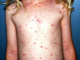 Chickenpox lesions on child