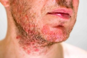 Folliculitis on the face