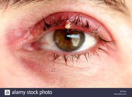 Sty at the base of the eyelid