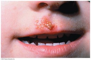 Impetigo on the lip