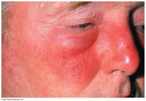 Erysipelas on the face
