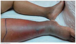 Cellulitis on the leg