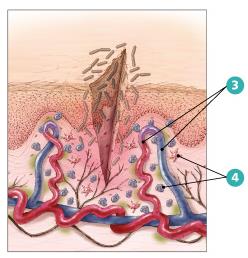 Diagram of the inflammatory response: diapedesis of phagocytes