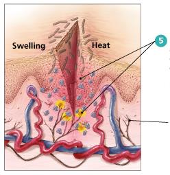 Diagram of the inflammatory response: swelling and pain
