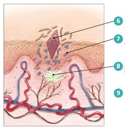 Diagram of the inflammatory response: pus formation and tissue repair