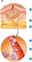 Diagram showing the process of inflammation and phagocyte migration