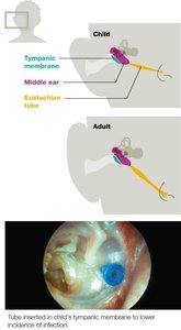 Anatomy of the ear in children and adults, showing tube insertion for otitis media