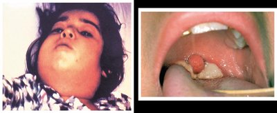 Clinical presentation of diphtheria with bull neck and pseudomembrane