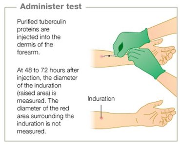 Administering the Mantoux tuberculin skin test