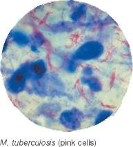 Acid-fast stained Mycobacterium tuberculosis cells