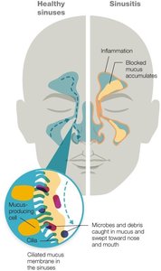 Healthy sinuses vs. sinusitis, showing mucus accumulation and inflammation