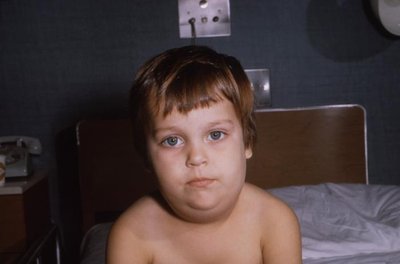 Child with mumps (parotid swelling)