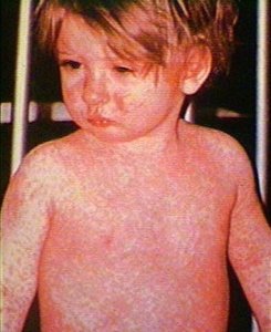 Measles rash on child