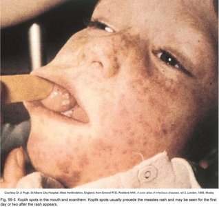 Measles rash (exanthem)