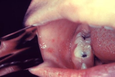 Koplik spots in measles