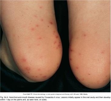 Hand-foot-mouth disease rash on soles