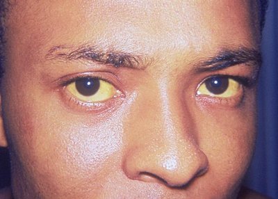 Jaundice from Hepatitis A