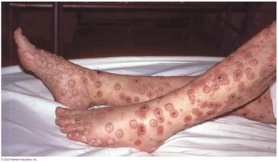 Smallpox lesions on legs
