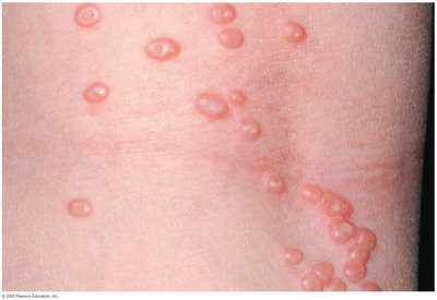 Molluscum contagiosum lesions on skin