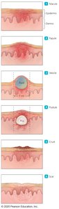 Stages of poxvirus lesions