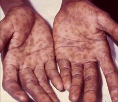 Clinical presentation of syphilis on hands