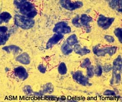 Acid-fast stain of Mycobacterium tuberculosis