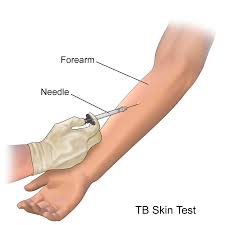TB skin test