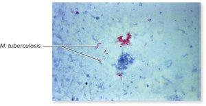 Ziehl–Neelsen stain of M. tuberculosis