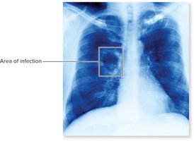 Chest X-ray showing area of TB infection