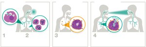 Stages of tuberculosis infection
