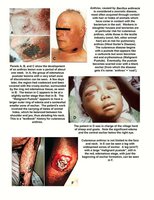 Anthrax lesions and effects on human tissue