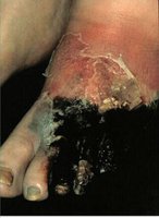 Diabetic gangrenous foot