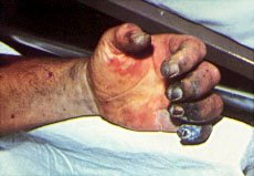 Blotches on skin of patient with plague