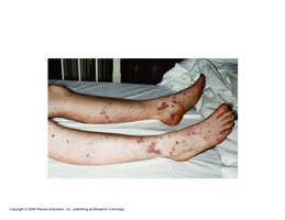 Petechiae on legs, a sign of bacteremia
