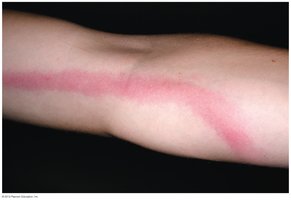 Lymphangitis: inflamed lymph vessel with red streak under the skin