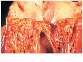 Bacterial endocarditis: fibrin-platelet vegetations on heart valves