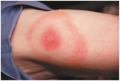 Bull’s-eye rash of Lyme disease