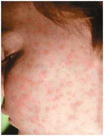 Rash characteristic of Rocky Mountain spotted fever