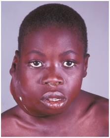 Child with Burkitt’s lymphoma